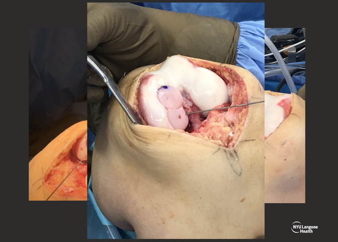 Cartilage Case of the Month - KM