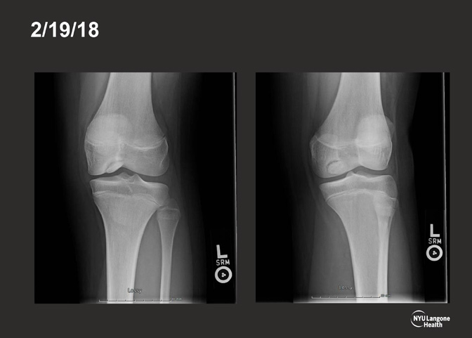Cartilage Case of the Month - KM