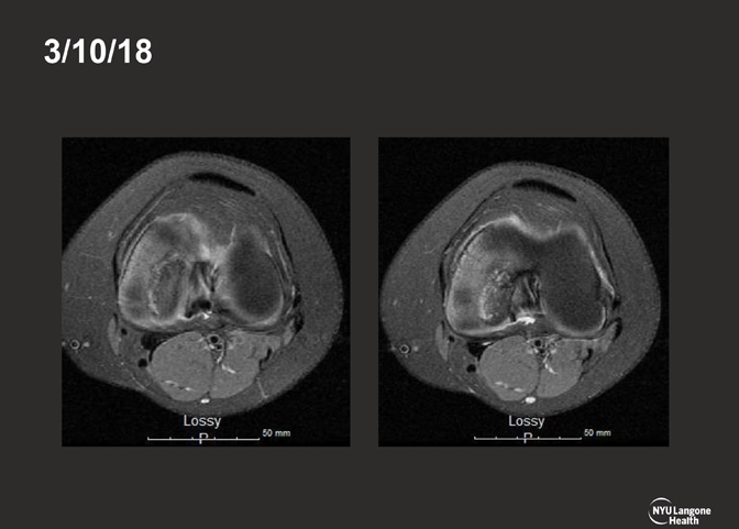 Cartilage Case of the Month - KM