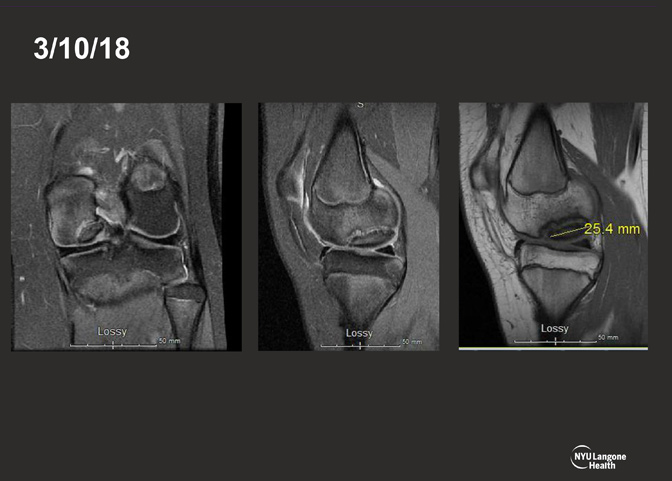 Cartilage Case of the Month - KM